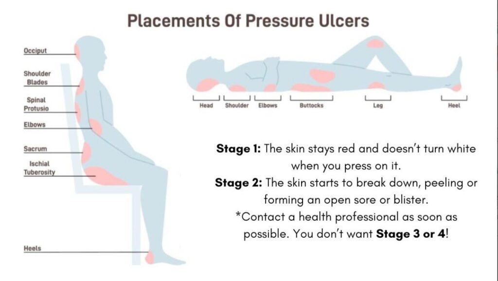 locations to prevent pressure sores